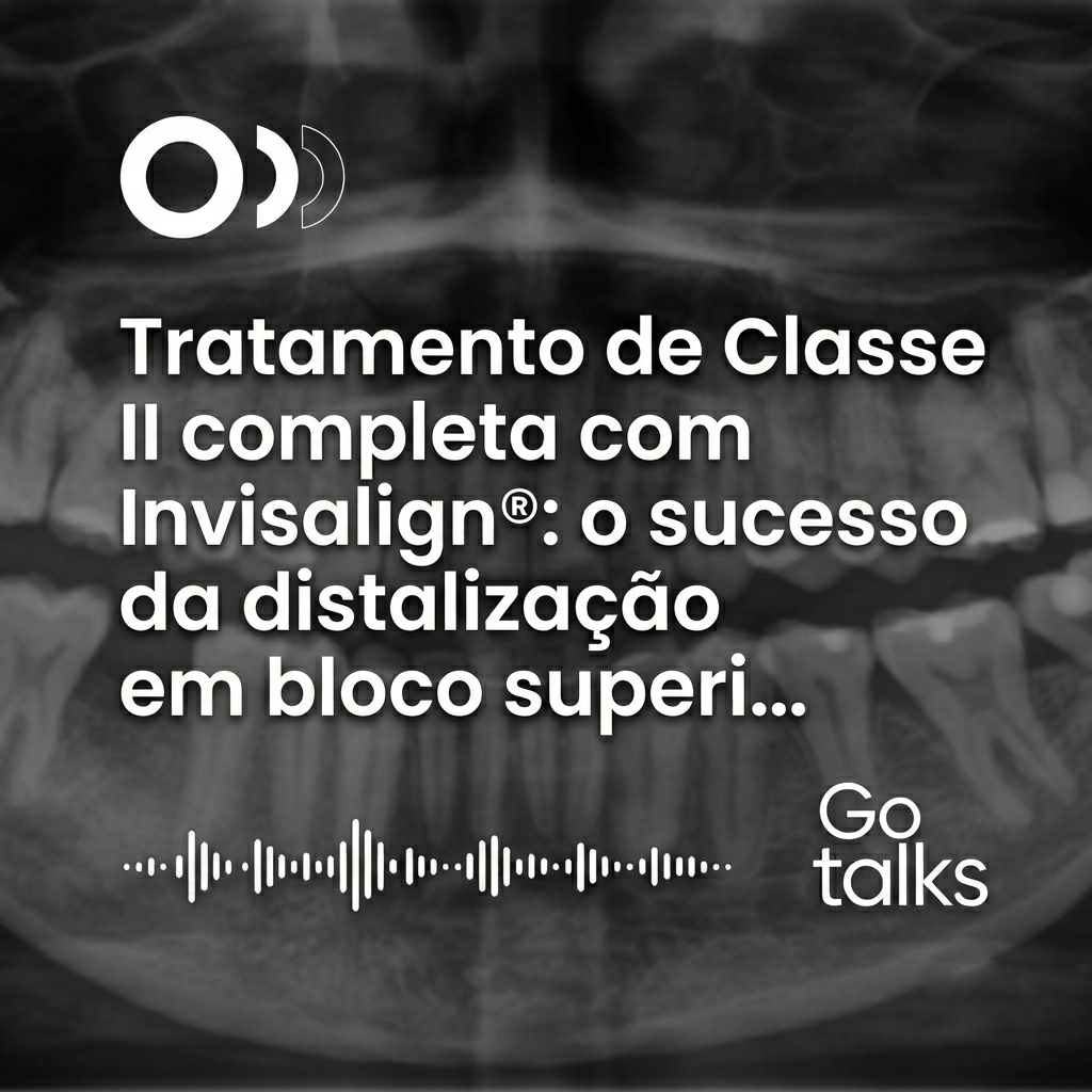 Tratamento de Classe II completa com Invisalign®: o sucesso da distalização em bloco superior sem a remoção imediata de terceiros molares
