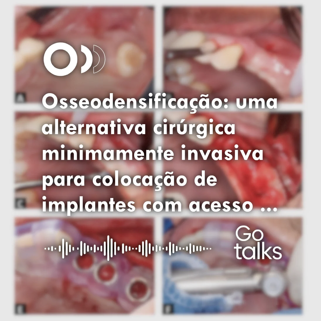 Osseodensificação: uma alternativa cirúrgica minimamente invasiva para colocação de implantes com acesso transcrestal ao seio maxilar: relato de caso